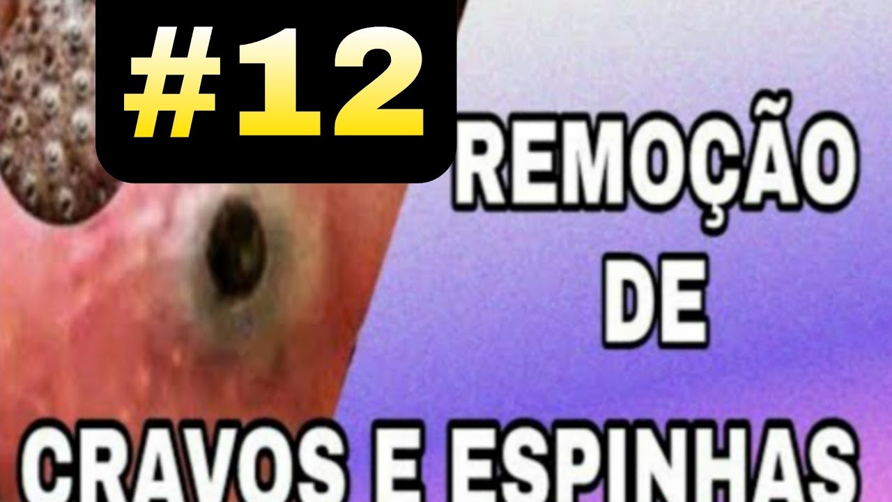 TIRANDO CRAVOS DO ROSTO 2022 - SATISFATÓRIO blackheads #12 - YouTube