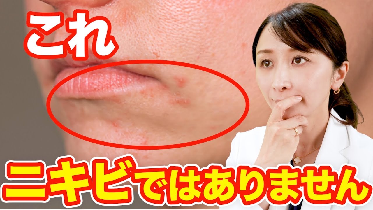 【誤診】ニキビに見えてニキビではない疾患を皮膚科医が解説します。