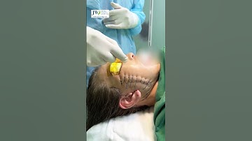 Căng da mặt SMAS Pro giúp quý bà TRẺ HƠN 10 TUỔI với tuổi thật