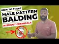 How to treat male pattern balding without chemicals