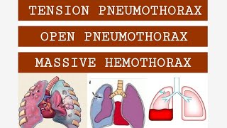 TENSION PNEUMOTHORAX, OPEN PNEUMOTHORAX & MASSIVE HEMOTHORAX