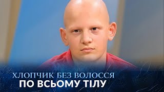 Дитина-ФЕНОМЕН. Хлопчик без волосся на тілі став сенсацією мережі! "Говорить Україна". Архів