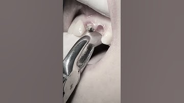 Extraction of remaining roots #dentist #dental #viralshorts