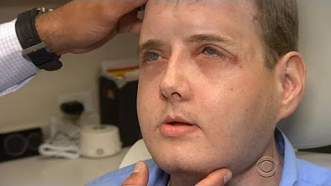Face transplant recipient thriving one year after ...