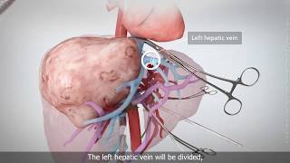 Extended right hepatectomy with veno-veno bypass
