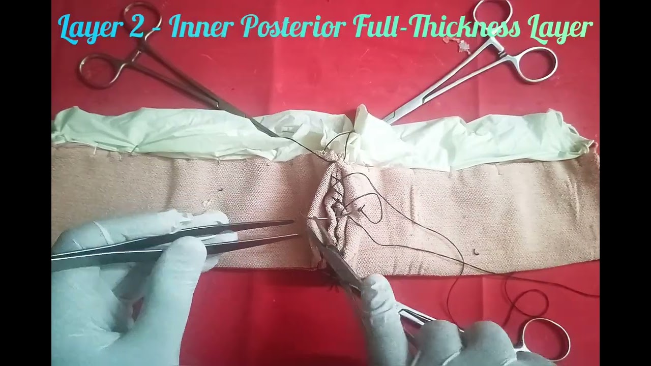 Анастомоз кишечника «конец в конец» — традиционное четырехслойное закрытие 🪡