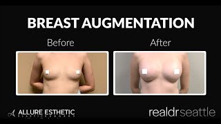 Breast Augmentation Surgery with the most DRAMATIC Results! 515cc Gummy Bear Implants | 2021 Surgery