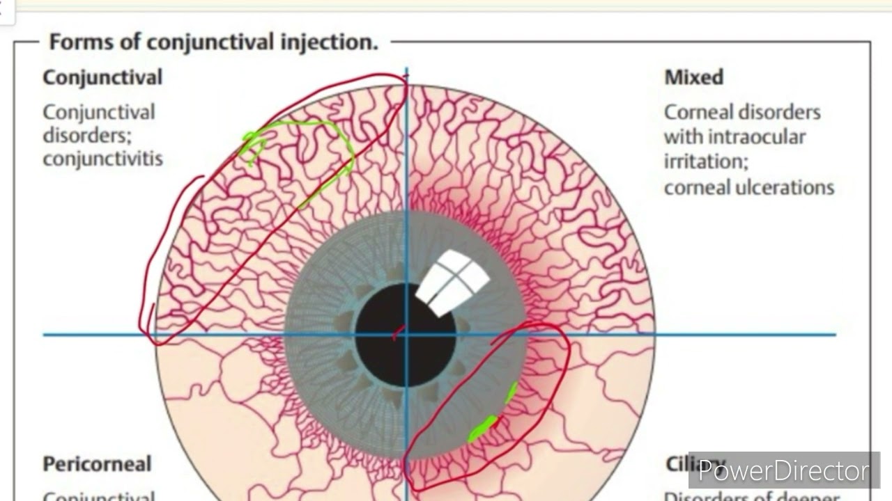 Conjunctiva | Red eye | Conjunctival and Ciliary Congestion ...