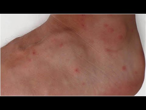 How to Identify and Treat Mite Bites | Tita TV