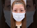 ナチュラルに変化するなら眉下リフト❤️🔥 #眉下切開 #眉下リフト #ダウンタイム #美容整形