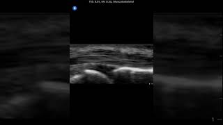 MSK A1 Pulley | Clinical Image