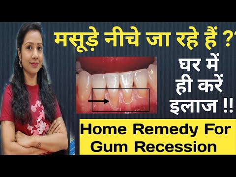 मसूड़े की समस्या घरेलू उपचार |मसूड़े की मंदी का घरेलू उपचार |मसूड़ों को कम करने का उपाय