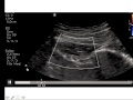 Pain Medicine - Quadratus Lumborum, Psoas and Piriformis Muscle Injection