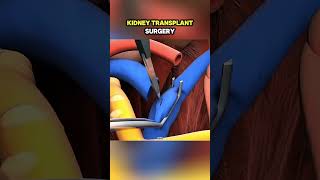Kidney transplant surgery(3-D Animation)#KidneyTransplant #OrganTransplant #MedicalWorld3D