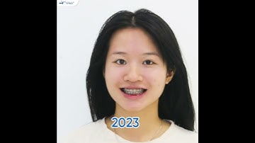 Răng Hô Thay Đổi Thế Nào Sau Niềng Răng?| Lạc Việt Intech Niềng Răng #shorts