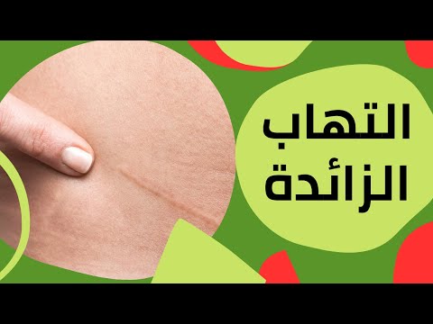 أعراض التهاب الزائدة الدودية والفرق بينها وبين وجع القولون