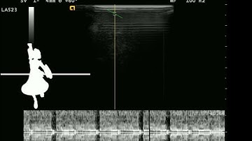 Bad Apple recorded through a Doppler Ultrasound Machine