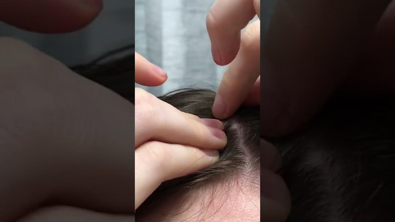 頭ニキビの潰し方 Youtube 頭ニキビの潰し方 Youtube