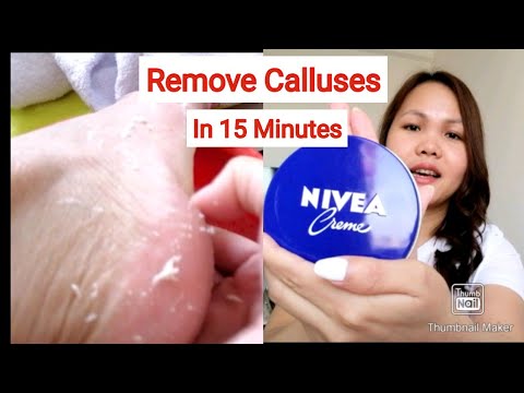 How to Remove callus from feet|Paano matanggal ang kalyo sa paa?Easy Home Remedy| Rylievers Channel