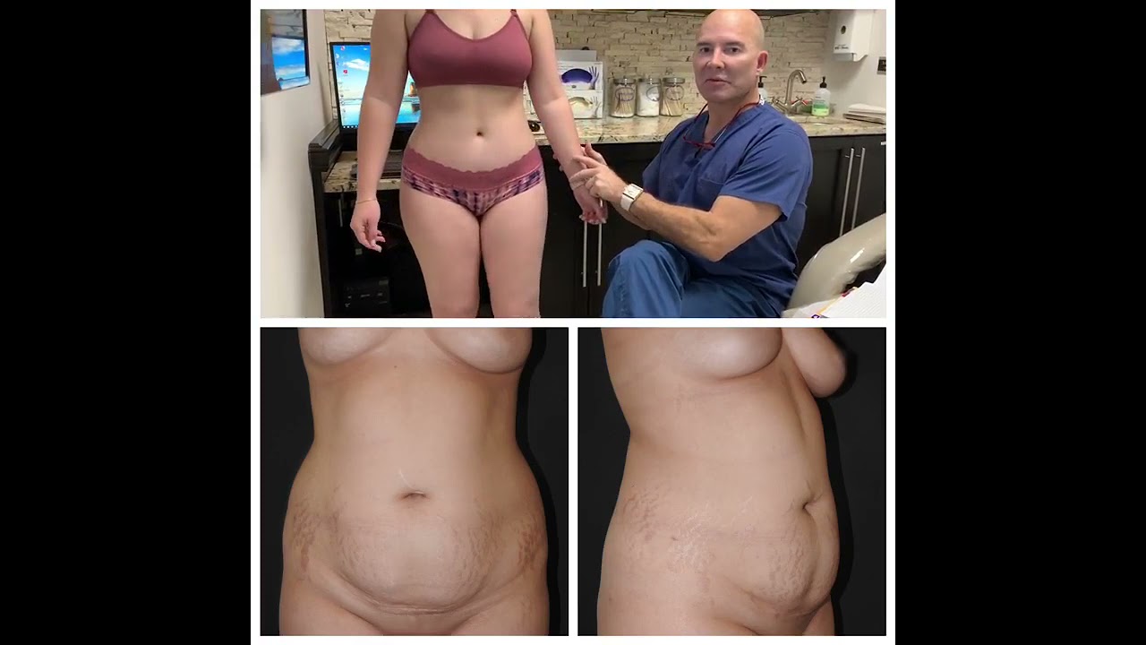 3 months post-op - Tummy Tuck, Liposuction and Fat Grafting (Makeover by Doctor Mendieta)