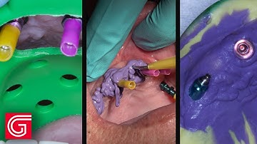 How to Take Full Arch Open Tray Impression for Implant Restoration