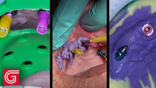 How to Take Full Arch Open Tray Impression for Implant Restoration screenshot 3