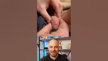 Doctor Reacts To INSANE Shooting Pimple Pop Dermreacts Doctorreacts Pimplepop 