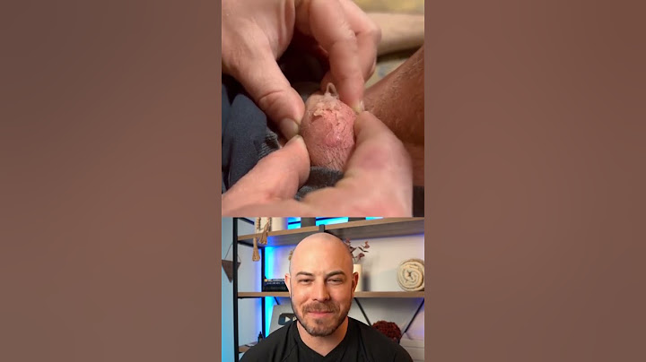 Doctor reacts to INSANE shooting pimple pop! #dermreacts #doctorreacts #pimplepop