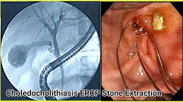 ERCP Stone Extraction #BD_ENDOSCOPY