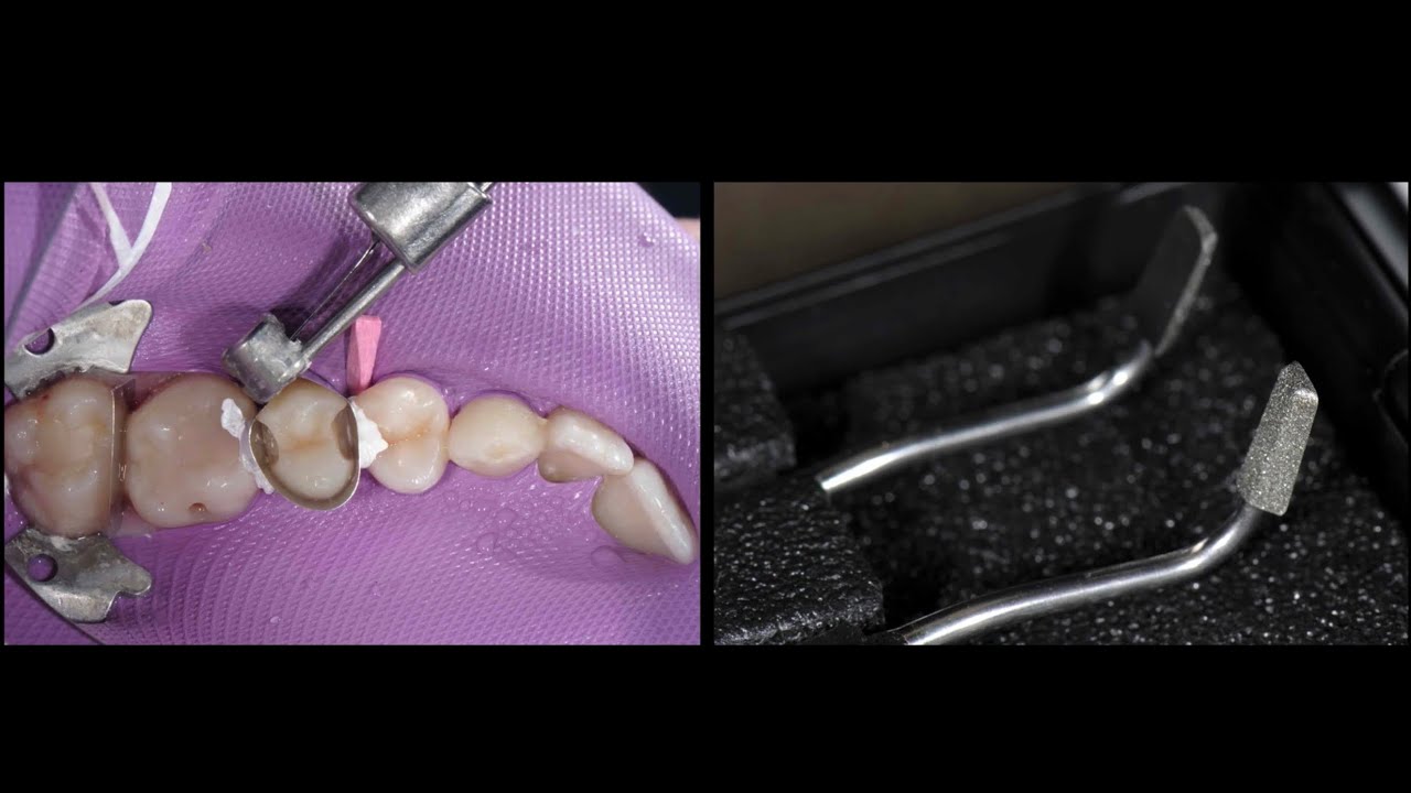 Dental Excellence Video 9 Class 2 Resin YouTube