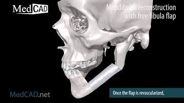 Mandibular Recon with Free Fibula Flap - Single Piece