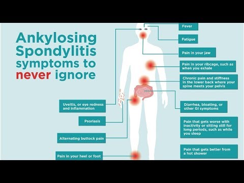 Video: Symptomen Van Een Opflakkering Van Spondylitis Ankylopoetica: Oorzaken En Meer