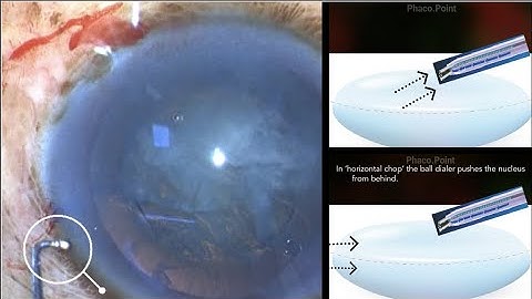 A simple technique for managing Soft Cataracts for the 