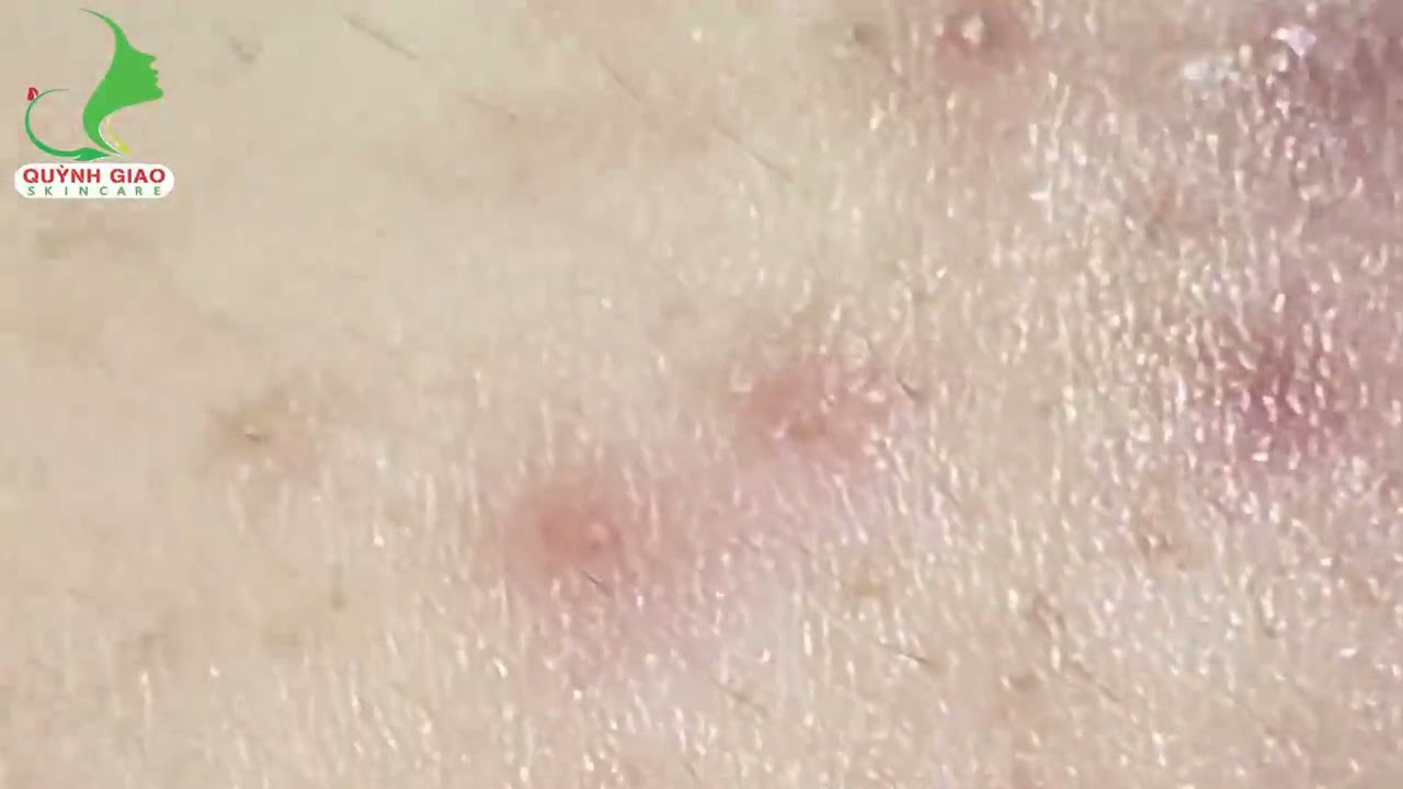 Biggest Blackhead Removal, Extraction A Massive Blackhead, Whiteheads