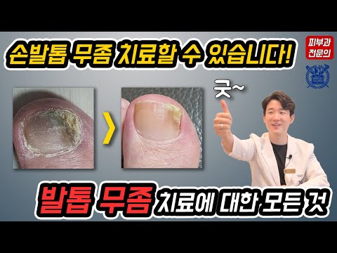 발톱무좀 치료 피부과 전문의가 알려드립니다 /발톱무좀약,발톱무좀레이저,발톱무좀제거/ 닥터피부광 /