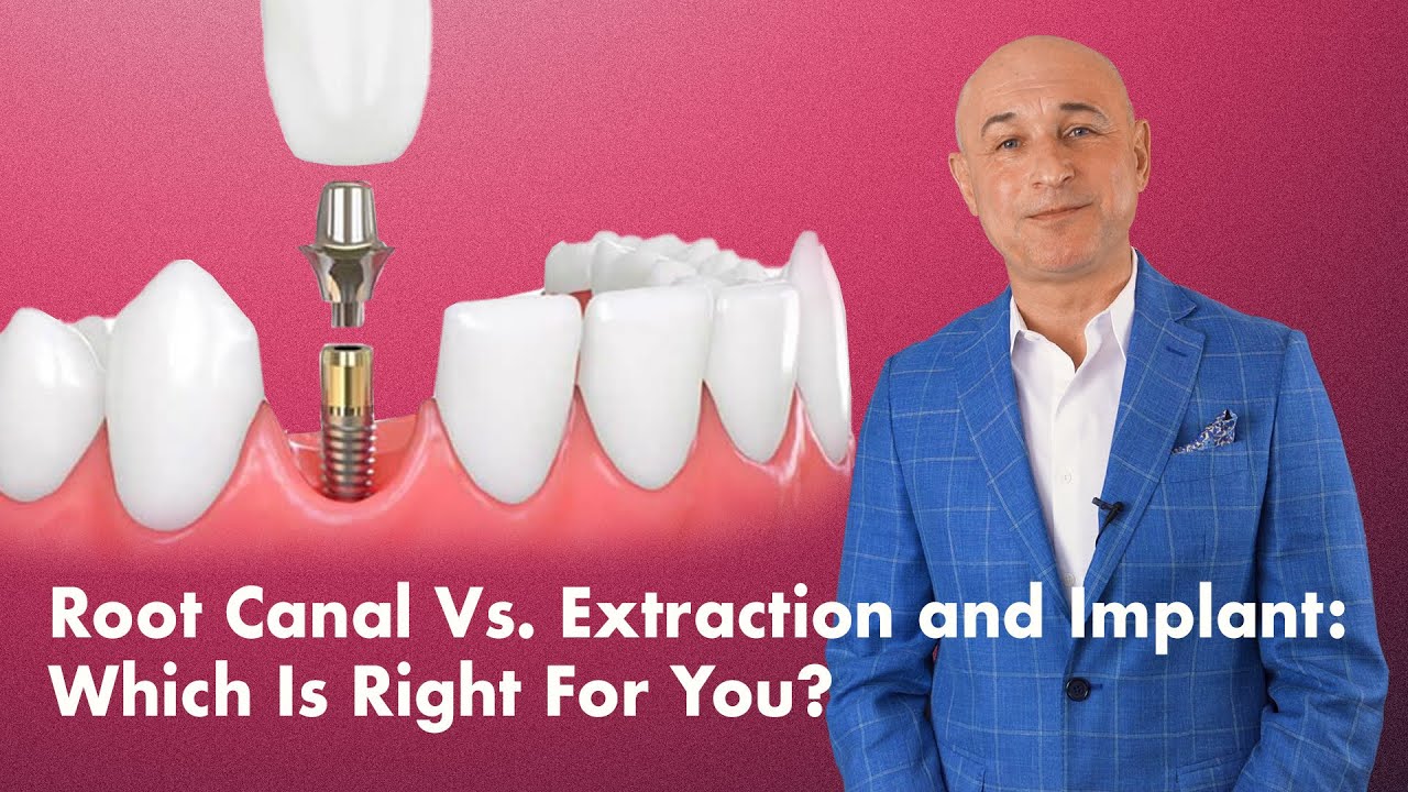 Root Canal Vs. Extraction and Implant Which Is Right For You? YouTube