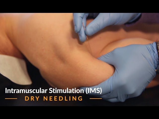 Dry Needling / Intramuscular Stimulation (IMS)​ - Trifecta Rehab