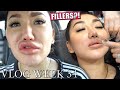 OPENING UP ABOUT FILLERS | VLOG WEEK 34