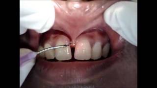 Thumbnail of Laser Labial Frenectomy Video Part1 - Zolar Dental Diode Laser