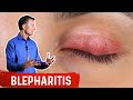 For Inflamed Eyelids Do This...