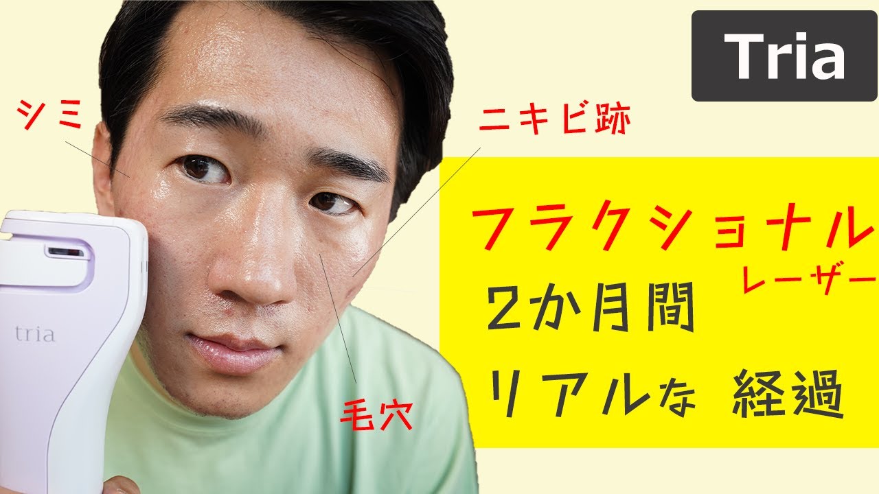 トリア フラクショナルレーザー 試してみた】トリア トリア・スキン エイジングケアレーザーの