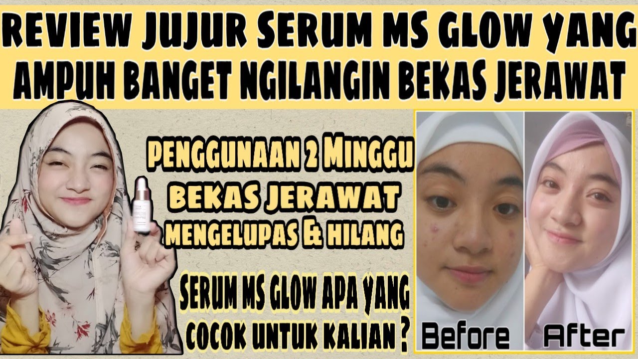 Ms glow menghilangkan bekas jerawat