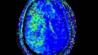 Download Lagu Moya Moya Disease MP3