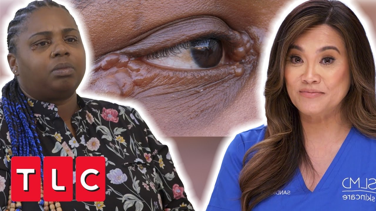 Dr. Lee Needs To Put A Needle In Patient's Eye To Remove These Lumps! | Dr. Pimple Popper