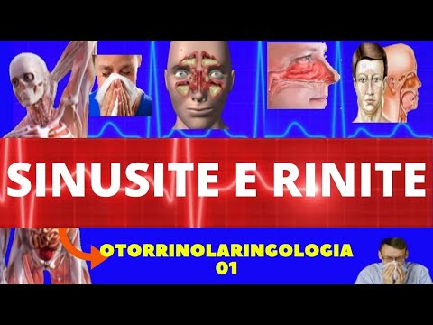 SINUSITE E RINITE (CAUSAS, SINTOMAS E TRATAMENTO) - OTORRINOLARINGOLOGIA (RINUSSINUSITE AGUDA)