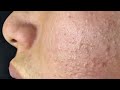Satisfying Relaxing With Vien Tham My DrAZI Vienthammydrazi0201 Acne Pimples Blackheads Satisfying Relaxing With Vien Tham My DrAZI Vienthammydrazi0201 Acne Pimples Blackheads