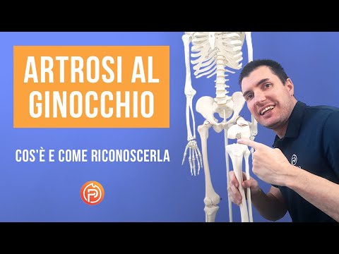 Video: Artralgia Al Ginocchio: Che Cos'è E Come Viene Trattata?