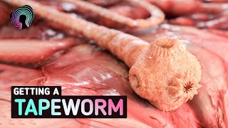 What Happens When You Get Tapeworms? (Warning: distressing footage)