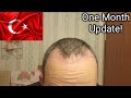 Turkey 🇹🇷 Hair Transplant 1 Month Update: Shedding 🐥