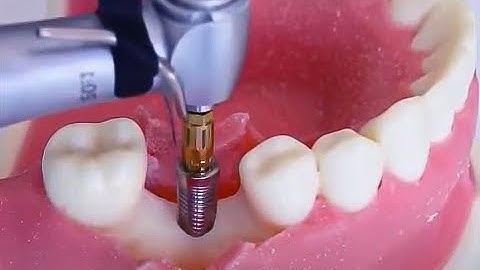 Trồng răng implant như thế nào? How to put in implant #dentist